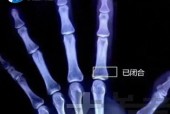 13岁男孩过度进补，一天吃四顿身高定格170