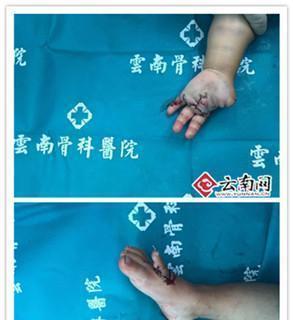 手被绞入电风扇会有什么后果？  第3张