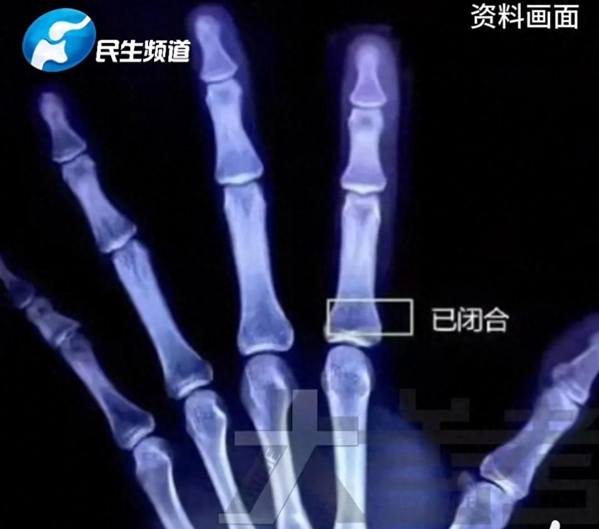 13岁男孩过度进补，一天吃四顿身高定格170  第1张