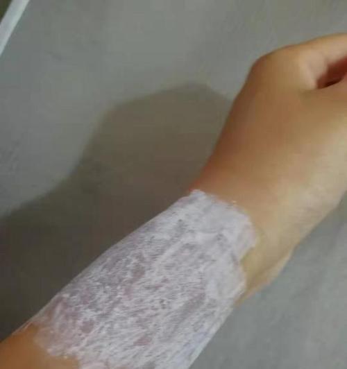 小米手环9导致过敏的原因是什么？如何预防过敏反应？  第2张